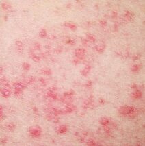 Referenzfall: allergisches Exanthem